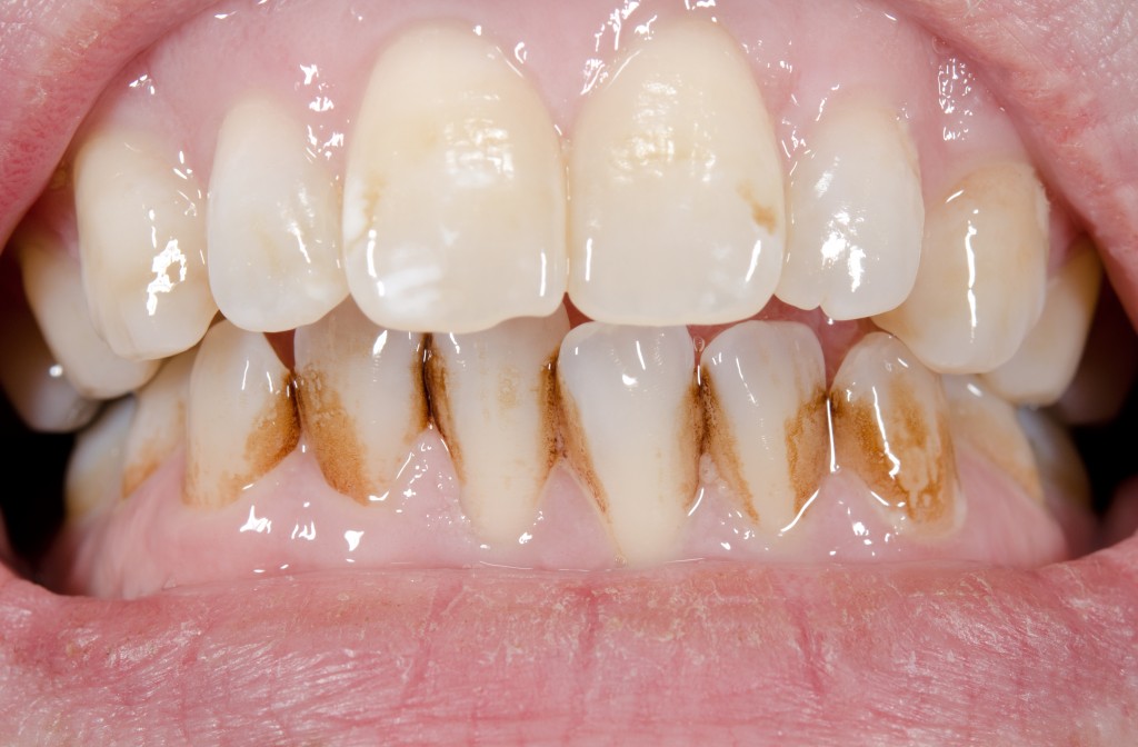 Patient before prophylactic treatment, dirty brown teeth