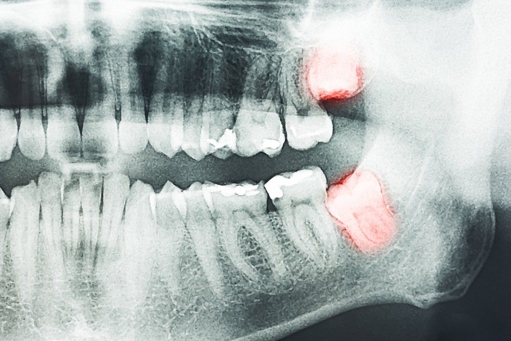 xray of wisdom teeth