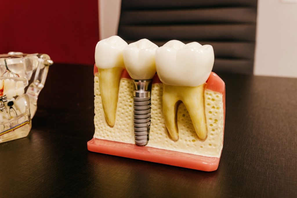 dental implant