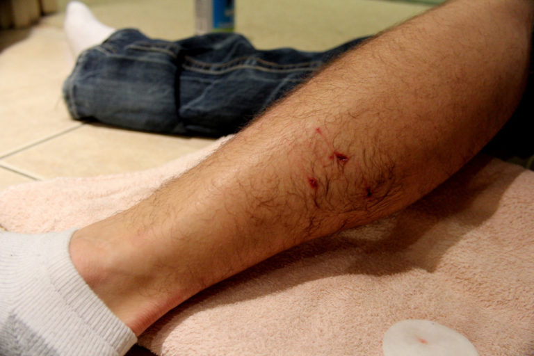 Tetanus Arm Example What Is Tetanus and How to Prevent It - House of Gordon
