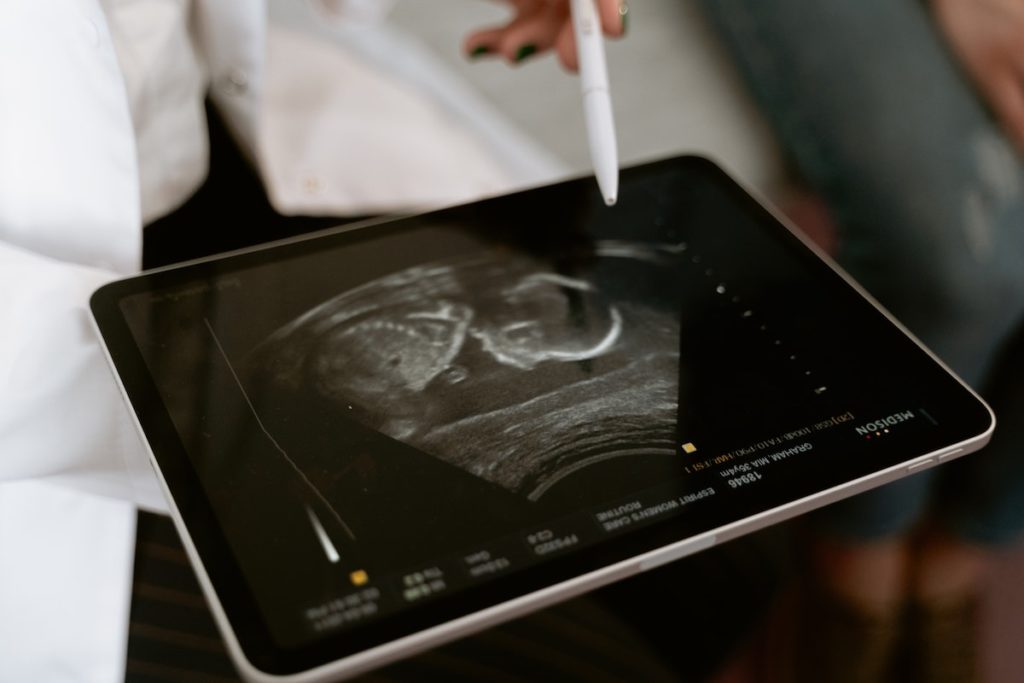 ultrasound of a fetus